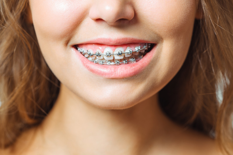 Giải đáp: Khi nào nên niềng răng để mang lại hiệu quả | Medlatec
