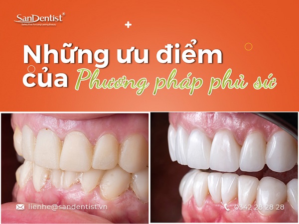 Khách hàng review phủ răng sứ thẩm mỹ tại nha khoa San Dentist