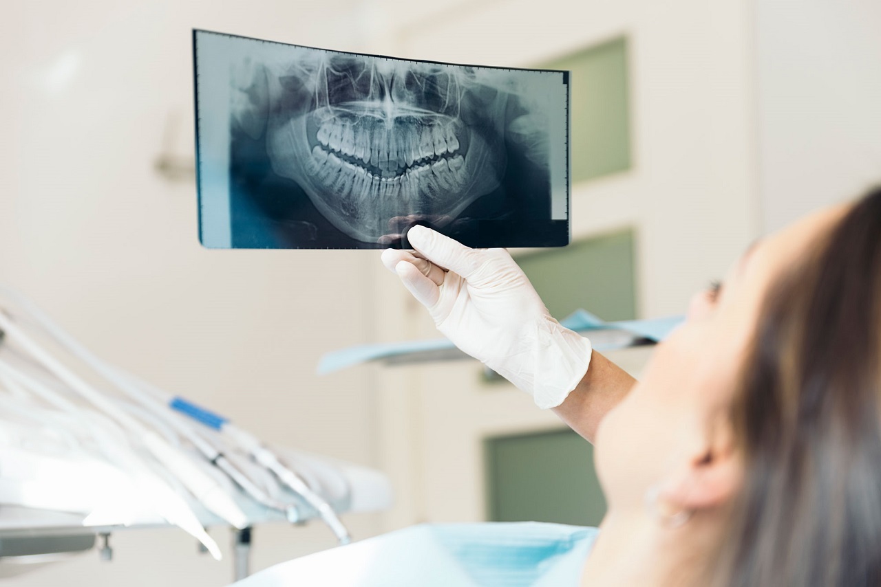 Chụp X quang răng là gì và những điều bạn cần biết | TCI Hospital
