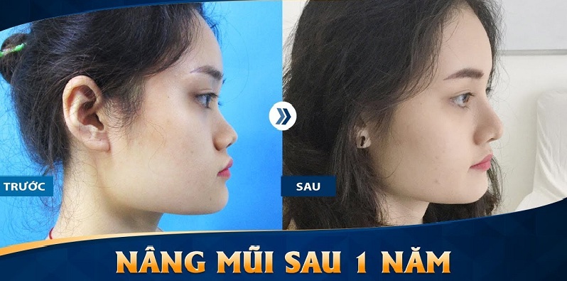 Hình ảnh trước và sau nâng mũi 1 năm