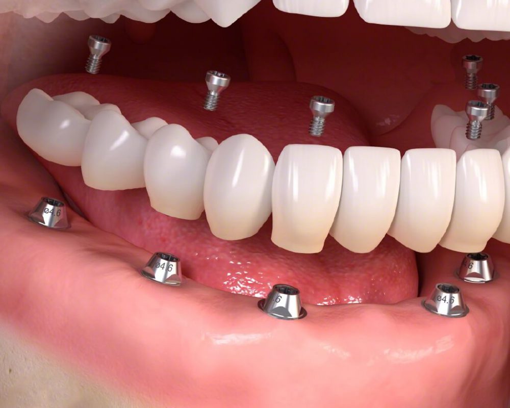 Trồng răng implant nguyên hàm lựa chọn phục hình răng hoàn hảo
